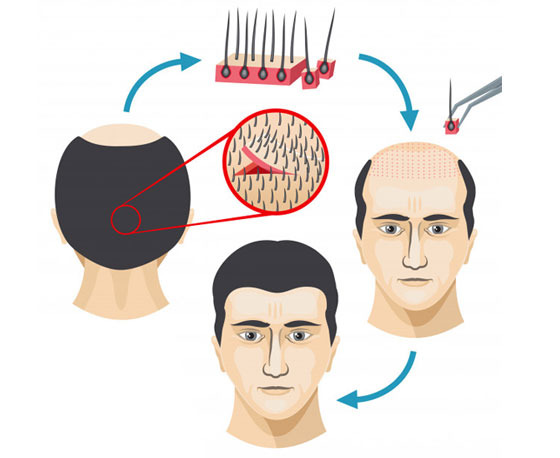 معایب کاشت مو چیست ؟
