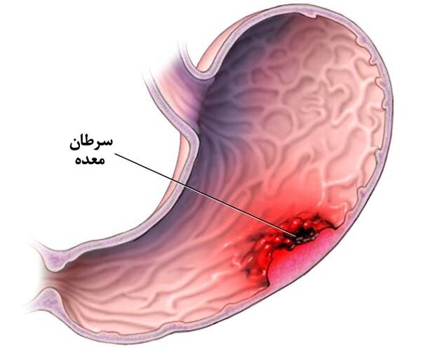 چرا مردان در خطر دو برابری سرطان معده هستند؟