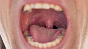 به شرایطی که می تواند نشانه سرطان دهان باشد توجه کنید