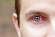 شایع ترین علائم چشم صورتی چیست؟