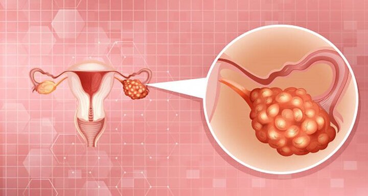 افزایش موارد سرطان تخمدان