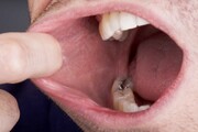 نواحی خاصی در دهان که سرطان می‌تواند شروع شود (همراه با علائم)