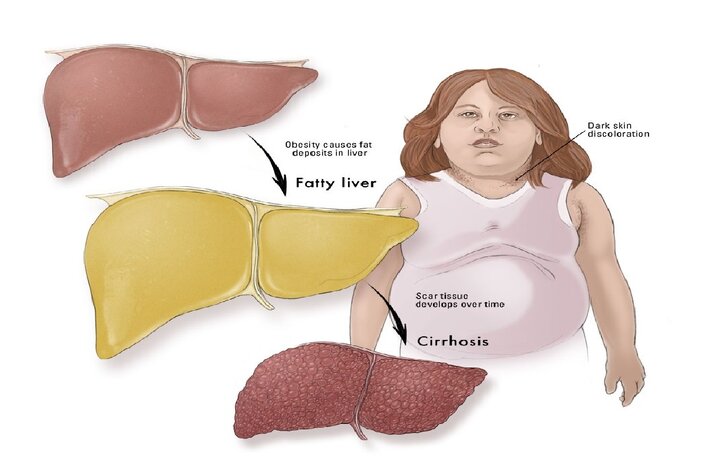  شناسایی علائم هشدار دهنده کبد چرب در کودکان