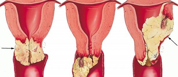 سرطان دهانه رحم چیست و چگونه تشخیص داده می شود ؟ 