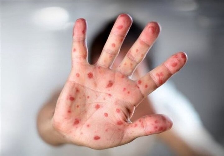 تأیید رسمی حذف سرخک و سرخجه در ایران